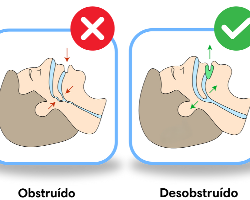 SILENT PRO® | ANTIRONQUIDO